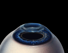 Ask Lasik Doctors
